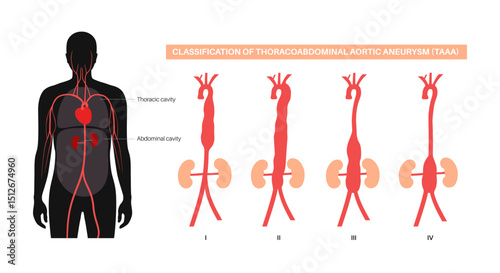 Thoracoabdominal aortic aneurysm