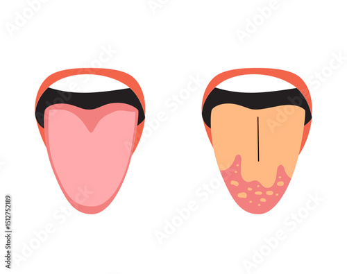 Cartoon comparison between a healthy tongue and one with candidiasis. Useful for health awareness and medical content
