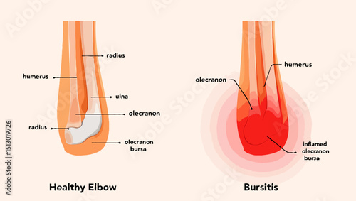 Healthy Elbow vs Bursitis: Anatomical Comparison Diagram
