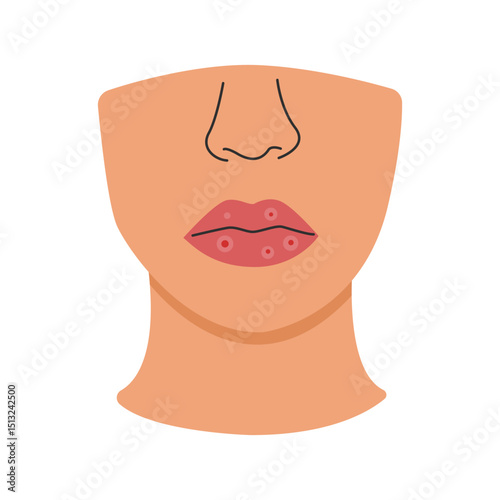 syphilis symptoms. syphilis disease concept