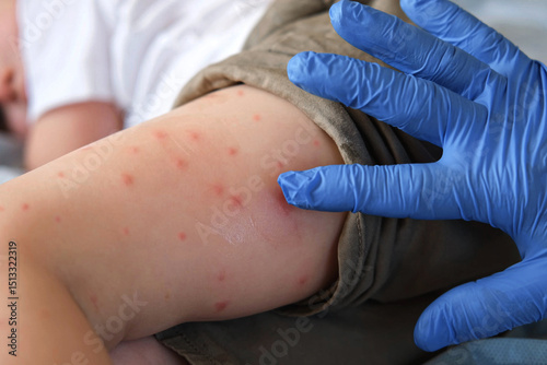 Doctor examining child with bodily red rash. Kid allergy closeup. Little baby scratches an eruption. Nurse applies special cream to atopic skin. Dermatitis, irritation, hive. Pruritus. Mosquito bites