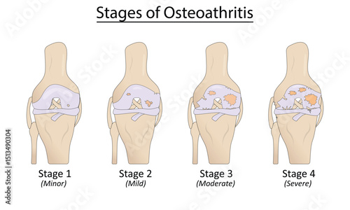Stages of osteoarthritis vector illustration