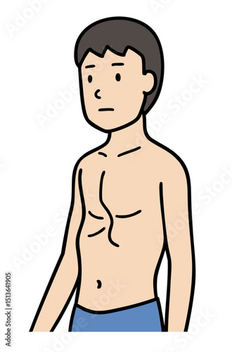 漏斗胸の男性、胸郭変形