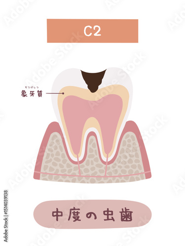 虫歯になる過程のC2のイメージイラスト