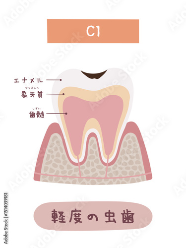 虫歯になる過程のC1のイメージイラスト