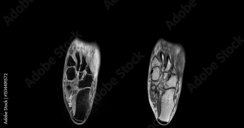 MRI foot scan for a diagnostic of the foot and ankle following symptoms: pain  both feet, swelling, redness or warmth, numbness or tingling and stiffness.