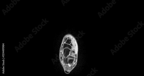 MRI foot scan for a diagnostic of the foot and ankle following symptoms: pain  both feet, swelling, redness or warmth, numbness or tingling and stiffness.