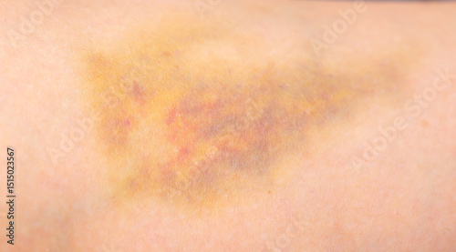 Bruises on the human body. Severe bruise from impact, bruising and hematoma.