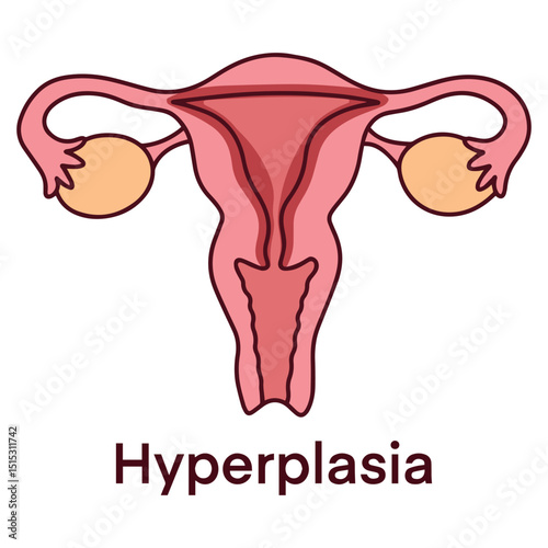 Medical illustration of uterus with hyperplasia, showing thickened endometrial lining. Educational visual for gynecology, pathology, and reproductive health