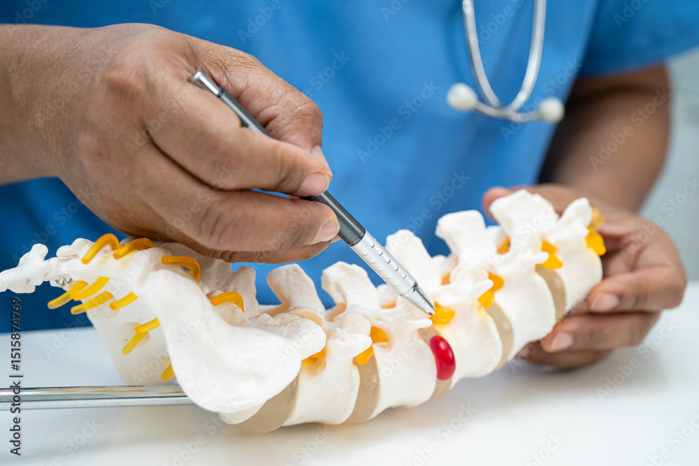 Φωτογραφία Asian doctor holding spinal nerve and bone model, Lumbar spine displaced herniated disc fragment for treatment medical in the orthopedic department