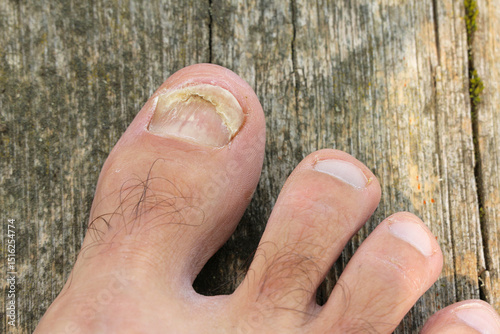 Ταπετσαρία Severe toenail fungus infection, deformed and thickened yellow big toenail, clos