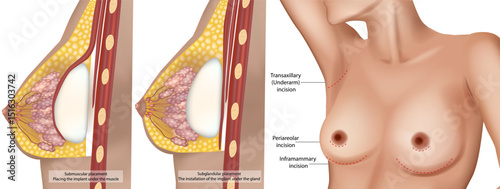 Detailed medical illustration showing two types of breast implant placements—submuscular and subglandular. The locations for breast augmentation surgery, including transaxillary, periareolar, and infr