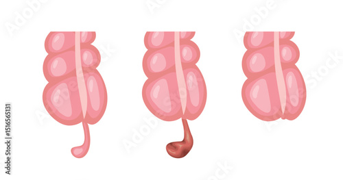 Appendicitis inflammation developing in three stages, from normal appendix to infected appendix