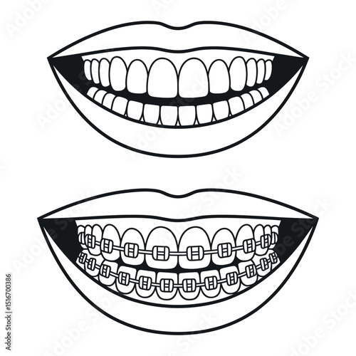 Comparison of Straight Teeth and Teeth with Braces