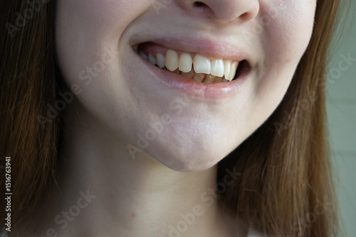 Close-up of a woman smile displaying dental malocclusion with pronounced overbite and misaligned front teeth.
