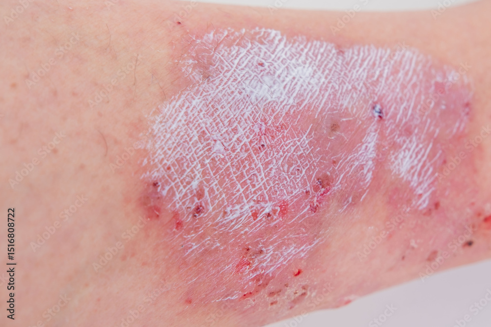 Fototapeta premium healing wound from on lower leg with scars adult female patient, redness, sores on limb, scarring of skin, concept of medical care, health care, human tissue regeneration, scald on women feet