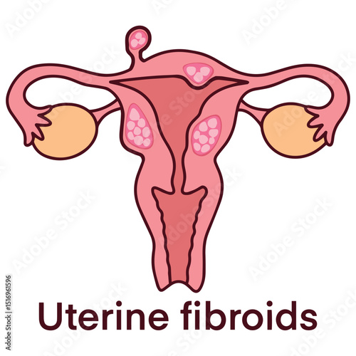 Medical illustration of uterus with multiple fibroid tumors. Educational vector used for gynecology, patient education, and diagnostic materials