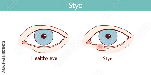 Stye eyes vector anatomical illustration