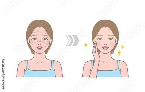 Before and after of cute woman with skin trouble as pimple, blackhead, whitehead, zit, blemish, acne, freckle, papule and woman with clear and clean skin