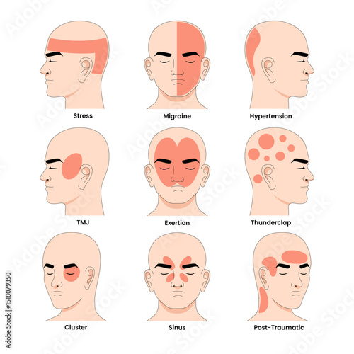 Different Types of Headache Syndrome Disorder, Educational Medical Poster Design Healthcare Scheme, Labeled Cluster, Exertion, Hypertension, Migraine, Post, Traumatic, Sinus, Stress, Thunderclap, TMJ.