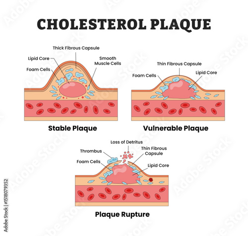Different Types of Cholesterol Plaque Types Set Collection, Educational Medical Poster Design Healthcare Scheme, Labeled Stable Plaque, Vulnerable Plaque, Ruptured Plaque. Vector Illustration.