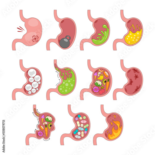 Different Types of Stomach Disease Set Collection, Educational Medical Poster Design Healthcare Scheme, Labeled Stomach, Acid, Reflux, GERD, Bloating, Burning, Full, Heaviness, Ulcer, Vomiting, Pills.