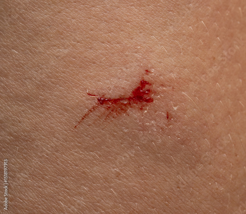 A small red mark on a person's arm