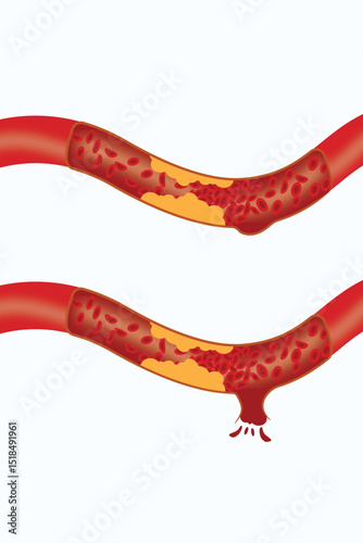 Illustration of artery plaque buildup and rupture causing internal bleeding and vessel damage.