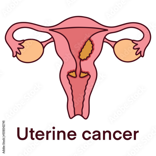 Medical illustration of uterus with uterine cancer. Depicts malignant growth in endometrial lining for use in education, diagnosis, and awareness campaigns