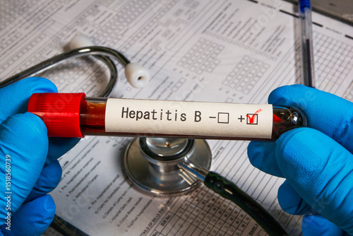 Doctor holding blood sample showing positive result for hepatitis b virus