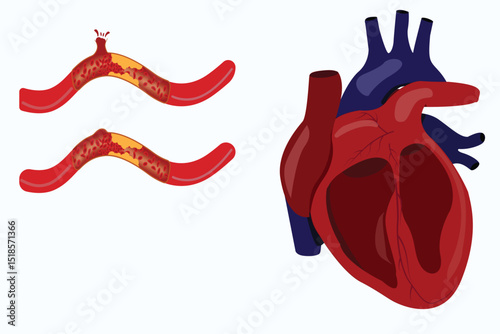 Anatomical heart and clogged arteries showing cardiovascular disease and blood vessel rupture.