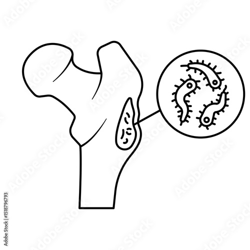 Bone DIsease