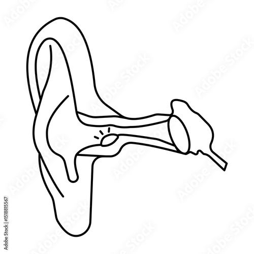 Otitis Externa