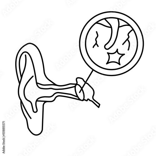 Ruptured Eardum