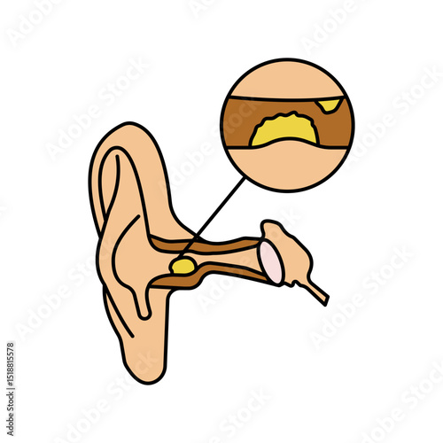 Earwax impaction disease
