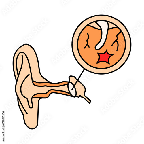 Ruptured Eardum