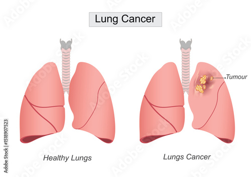 Lung cancer is a kind of cancer .
