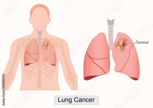Lung cancer is a type of cancer.