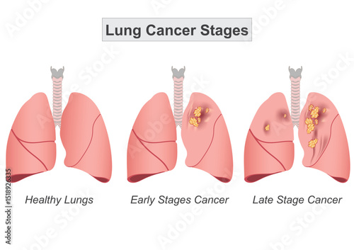 Lung cancer staging helps determine how much the cancer has spread.