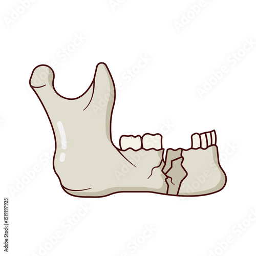 Mandibule Fracture