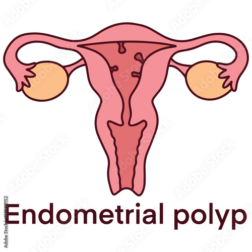 Medical diagram of uterus with endometrial polyp, a benign growth inside uterine lining. Used for gynecology, diagnostics, and reproductive education