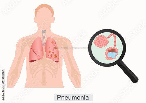 Pneumonia is a lung infection where the air sacs (alveoli).