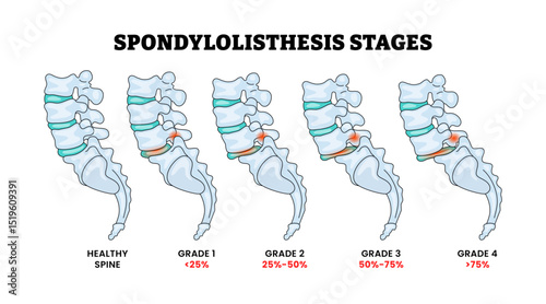 Spondylolisthesis Stages Grade Spine Disease Process Development, Educational Medical Poster Design Healthcare Scheme, Labeled Inflammation Tail Spinal Column Disc Backbone Vertebral Skeleton.