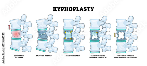 Kyphoplasty Surgery for Spinal Fractures Procedure. Educational Medical Poster Design Healthcare Scheme, Labeled Balloon, Inserted, Kyphoplasty, Removed, Cement, Compressed, Vertebrae, Hardens 