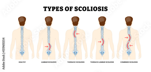 Different Types of Scoliosis Types. Spinal Deformation or Deformity Incorrect Spinal Alignment, Educational Medical Poster Design Healthcare Scheme, Labeled Lumbar, Thoracic, Thoracolumbar, Combined.