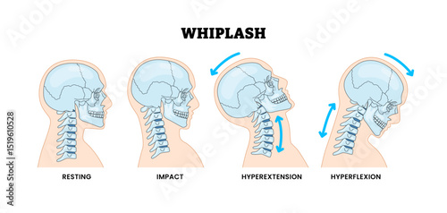 Whiplash Types, Head Skull Bones, Neck Injury and Spinal Trauma, Educational Medical Poster Design Healthcare Scheme, Labeled Hyperextension, Hyperflexion, Impact, Resting, Whiplash.