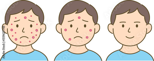 Before and After Acne Improvement – Step-by-Step Illustration