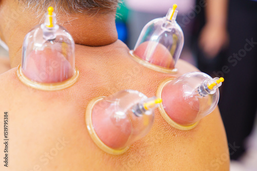 Close up for multiple vacuum cups, medical cupping therapy on human body. Doctor with cups for patient, therapy. Wellness, health injury rehabilitation concept. Alternative medicine