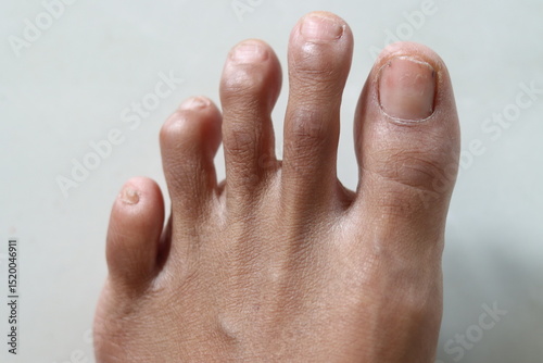 Left foot with the following conditions: Mallet toe, Hammer toe and Morton’s toe on one Black or Asian human foot.