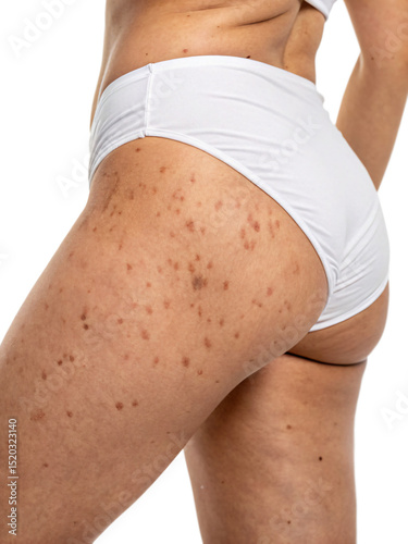 woman's buttocks with problematic skin and pimples and cellulite, isolated PNG transparent background